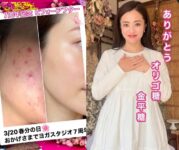 式部いろはストーリ。ヨガで肌改善したビフォーアフター